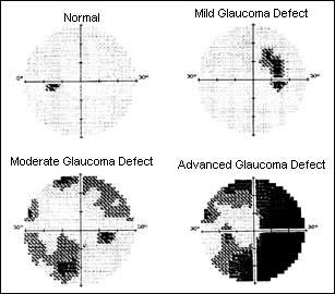 Image result for visual field test